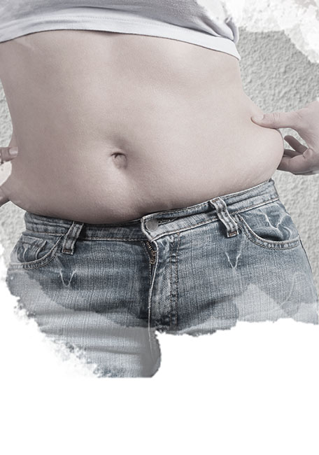 Abdominoplastia